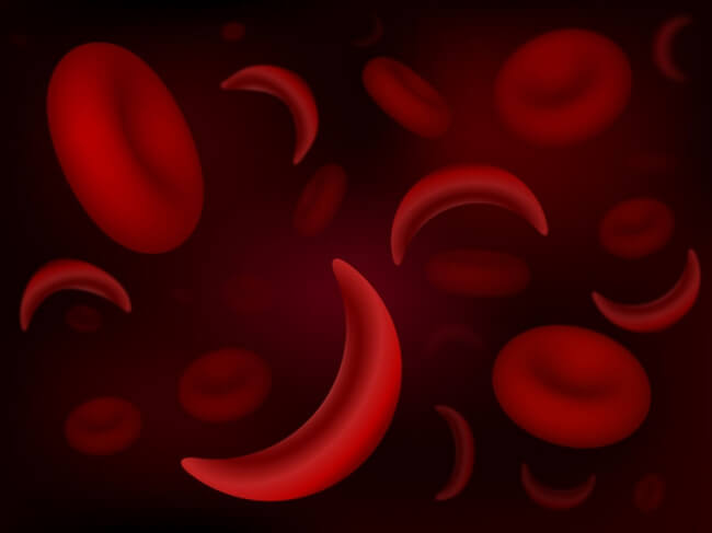 THINGS YOU SHOULD KNOW ABOUT SICKLE CELL ANEMIA